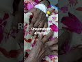 rheumatoid arthritis #rheumatoidarthritis #rheumatology #jointpain #jointdeformity #physiotherapy