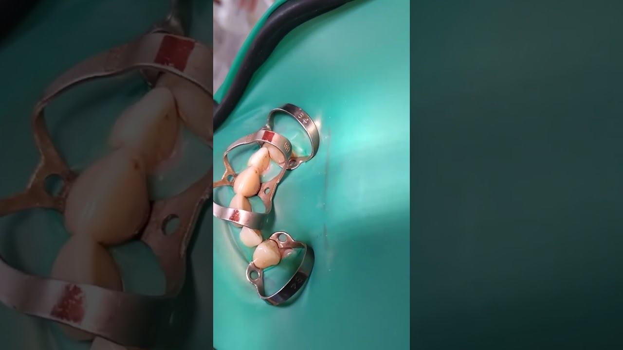 Isolation 13-23 teeth.