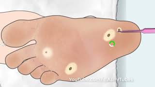 ASMR Treatment athletes foot and warts between toes at home | Foot care animation