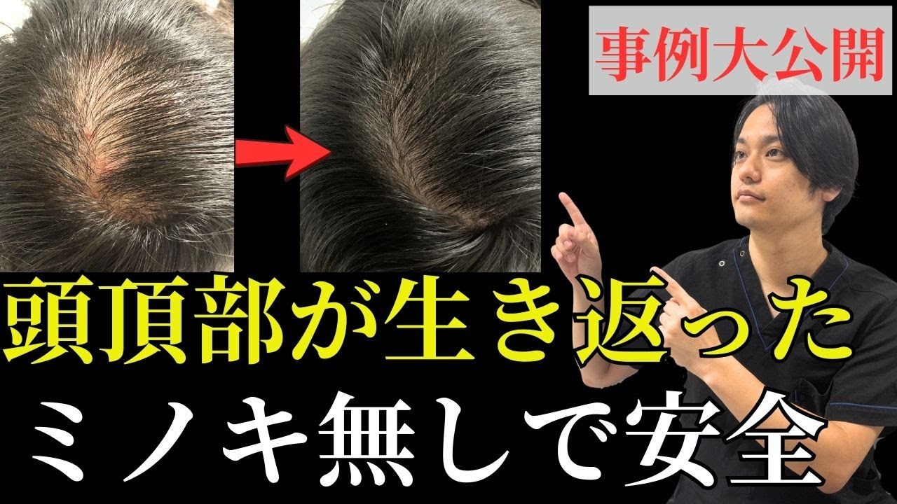 【副作用なし】ミノキシジルなしで髪の毛が生き返った事例を大公開