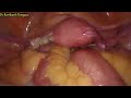 Hysterectomy surgery procedure explained by dr ravikanth kongara ravi hospital vijayawada