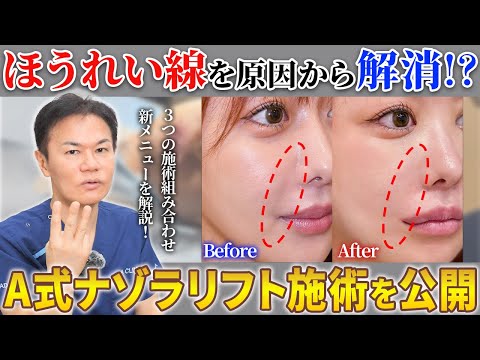 ほうれい線を1回でなくす治療をスタッフが受けた結果を術後1ヶ月まで公開【脂肪吸引×糸リフト×切開リフト】