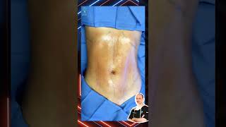 Natural Looking Results of Liposuction of waist & flank by Cosmetic Surgeon 🤩 | MoeinSurgicalArts