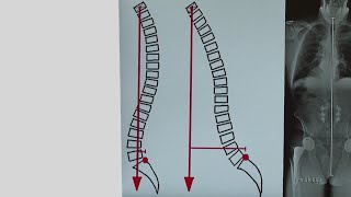 Your Healthy Family: Sagittal imbalance