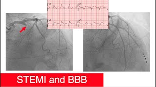 STEMIs and Left/Right Bundle Branch Blocks [Part 6]