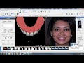 Digital smile design from helm nejad stanley   dentistry in west hollywood ca