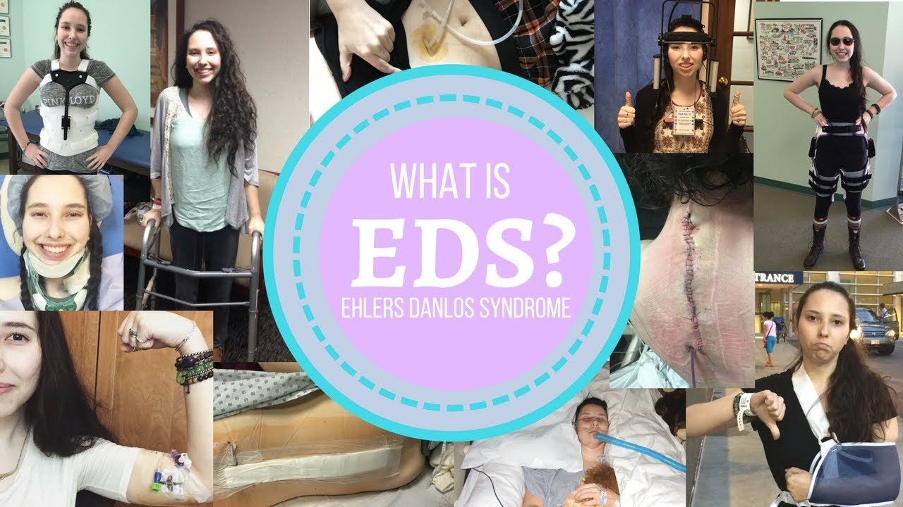 Living with EDS: What is Ehlers Danlos Syndrome? - YouTube
