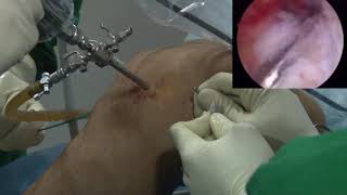 Controlled pulling, flipping and adjustment of BUTTONFIX® - Adjustable loop device