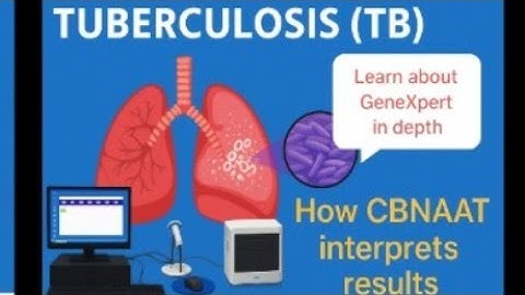 Interpretation of Results on CBNAAT/Genexpert for MTB Rif testing (Nucleic Acid Amplification test)