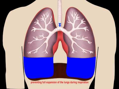 Image result for fluid in lungs