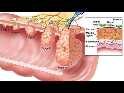 What to Expect from Stage 4 Bladder Cancer | Tita TV