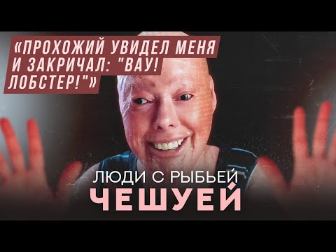 Видео: Люди с рыбьей чешуей: ихтиоз | Хочу спросить