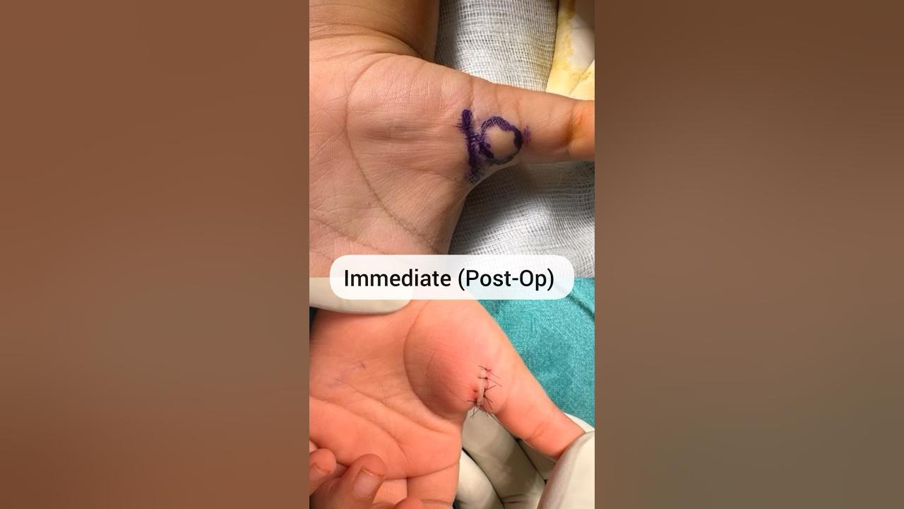 congenital-trigger-thumb-surgery-in-2-years-old-child-essence