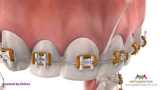 Life with Braces - Flossing
