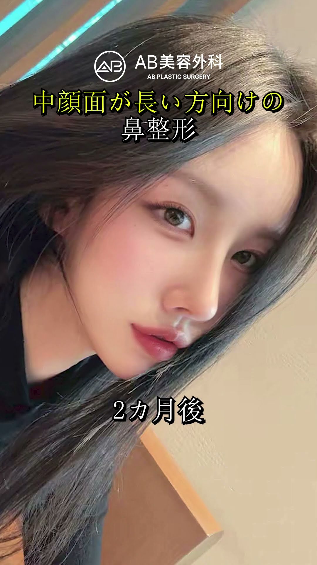 韓国で鼻整形｜カウンセリングから結果まで全部見せます #shorts