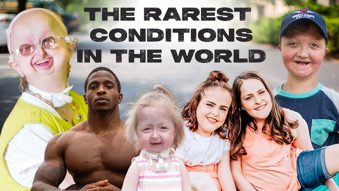 10 Of The Rarest Conditions In The World Born Different