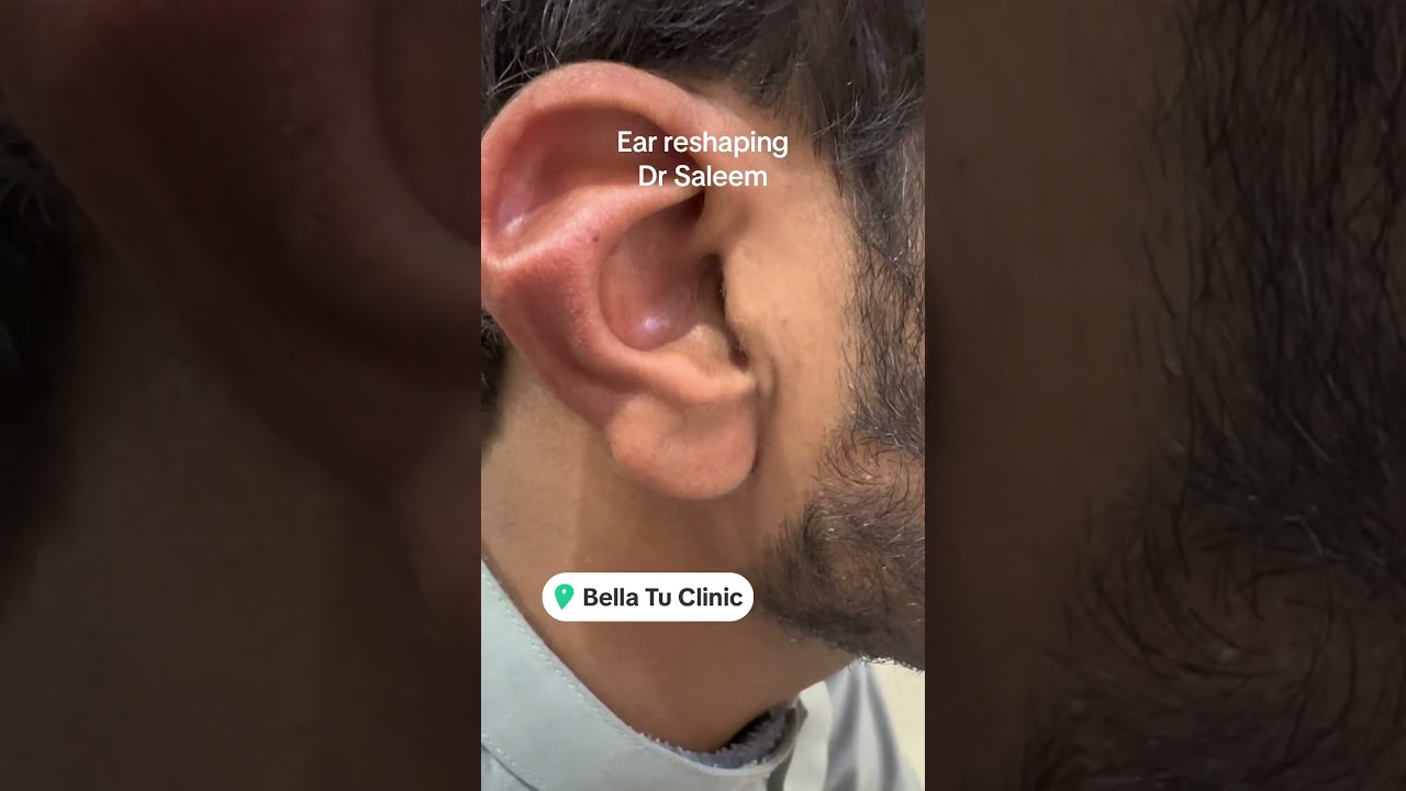 Ear reshaping surgery for stahl ear deformity