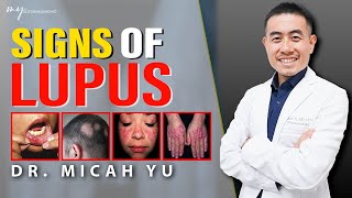 10 SIGNS of Lupus TO NOT MISS From a Rheumatologist | Dr. Micah Yu