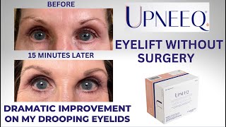 How to get an eye-lift without surgery over 55 years old. NEW Upneek Eye Drops Transformed my eyes!