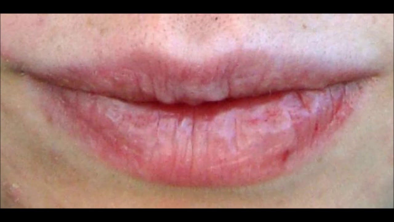 porque se me resecan los labios estando embarazada porque se me resecan los labios estando embarazada
