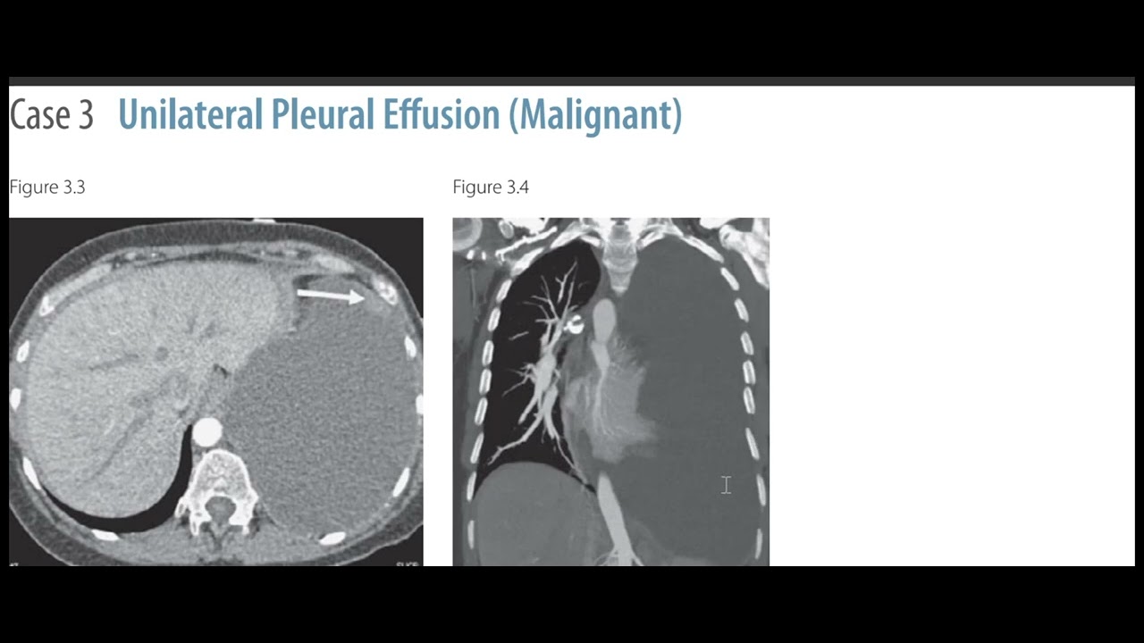Malignant pleural effusion thoracocentesis