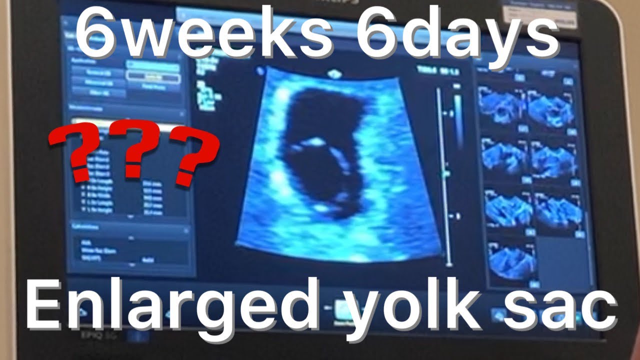 6w 6days ultrasound update Enlarged Yolk sac YouTube