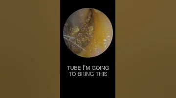 LARGE EAR WAX PLUG REMOVAL 