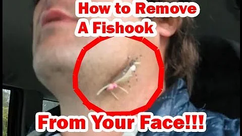 Hook Removal From Skin, How To Remove a Large Fish Hook From Your Face or Ear