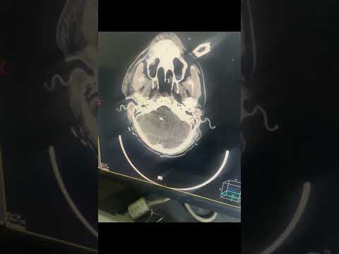 مفراس دماغ   عمليه نزيف في الدماغ