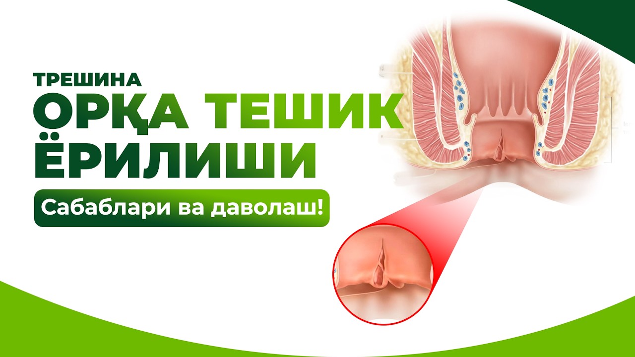 Орқа Тешик Ёрилиши | Трешина Сабаблари ва Даволаш | 78 555-82-82