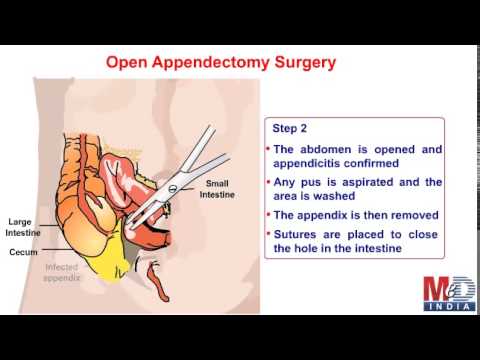 Types Of Appendectomy Youtube