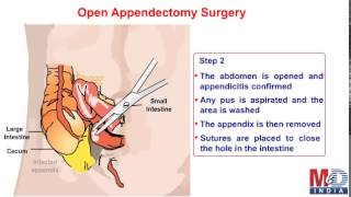 Types Of Appendectomy