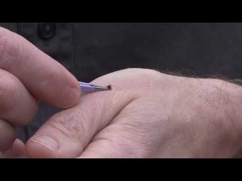 How to remove a tick the RIGHT way