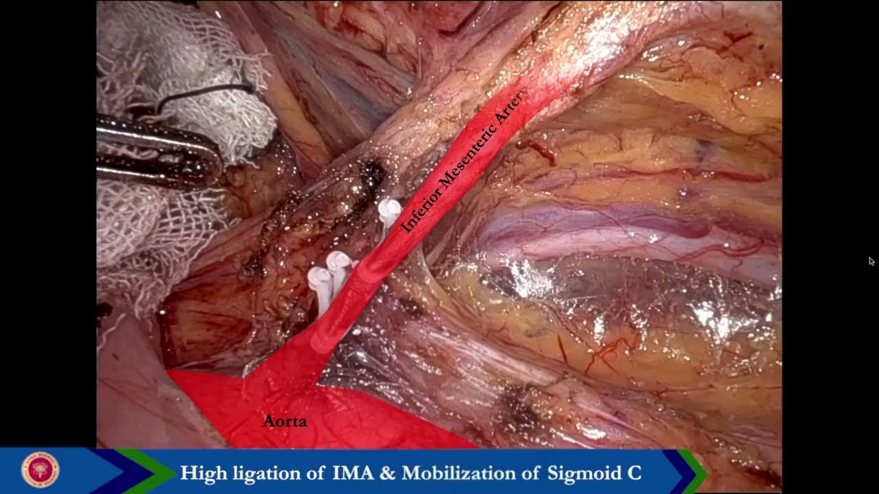 CLASP TME: Colorectal Lumen pull through & transAnal Stapling-a novel technique