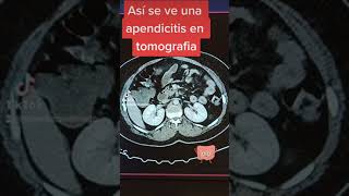 Appendicitis on CT Scan: Complicated by Plastron