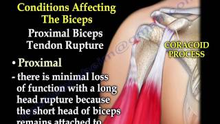 Biceps Tendon Pathology - Everything You Need To Know - Dr. Nabil Ebraheim