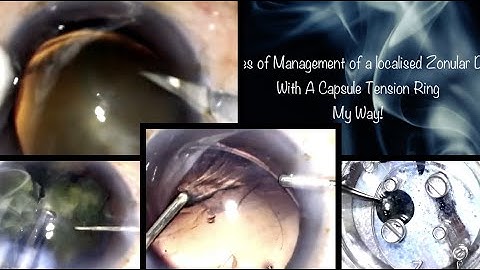 Principles of management of a localised Zonular Dialysis with a Capsule Tension Ring ( CTR) - My Way