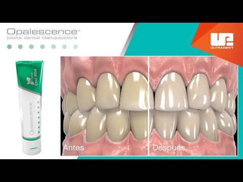 Vídeo: Funciona el blanquejament dental d'opalescència?