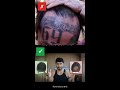 Best and Worst Hair Loss Treatments