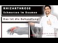 Rhizarthrose - das ist die Behandlung...| Schmerzen im Daumensattelgelenk | Dr. Alawi