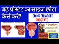 प्रोस्टेट को कैसे कम करें? Prostate size Reduction How ? .(Prof)Santosh Kumar PGI