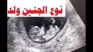 10 weeks male fetus جنين ولد ( ذكر ) 10 أسابيع دكتور يوسف عيد  DR YUSSIF EID