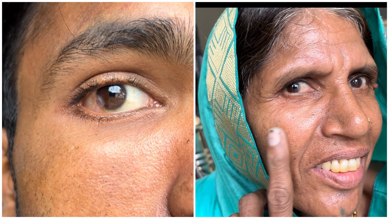 Mummy Or Meri Eyes Ki Surgery Hogi YouTube