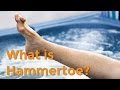 To Your Health Quick Takes: What is Hammertoe?