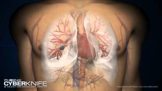 CyberKnife Lung Tumor Animation