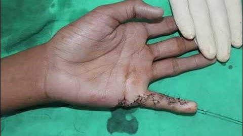 Z plasty for contracture 0001