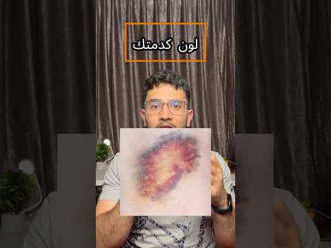 لون كدمتك له اهمية اكبر من ما بتتوقع           اكسبلور