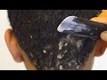 Scalp Scratching Dandruff!! Huge Flakes