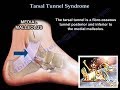 Tarsal Tunnel Syndrome - Everything You Need To Know - Dr. Nabil Ebraheim