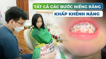 Gắn mắc cài điều trị răng khấp khểnh lệch lạc nặng như thế nào?